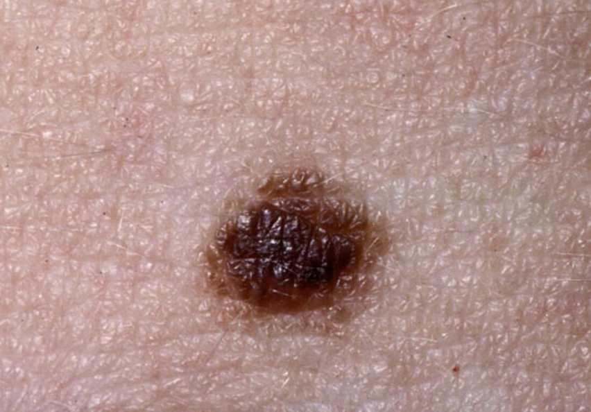 <p>Moles; concentrated areas of melanocyte. Should be monitored for any changes indicating cancerous overgrowth</p>
