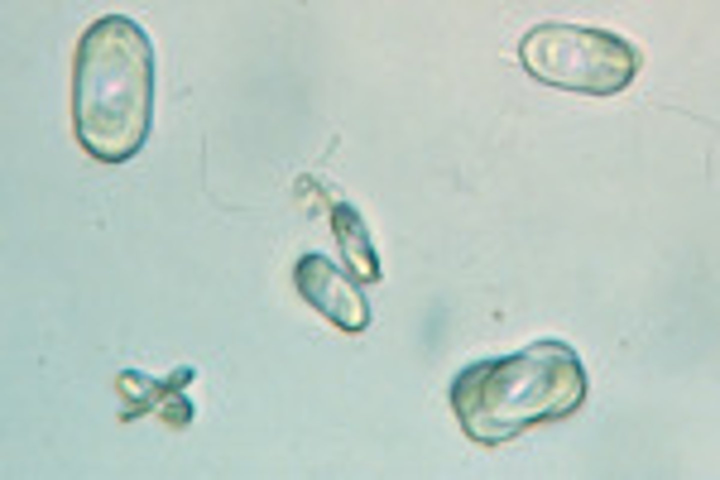 <p>ethylene glycol (antifreeze) poisoning</p>