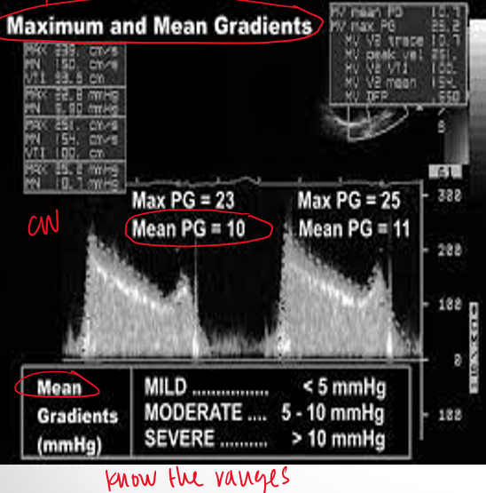 <p>CW/PW of mitral inflow through mitral leaflets and then trace</p>
