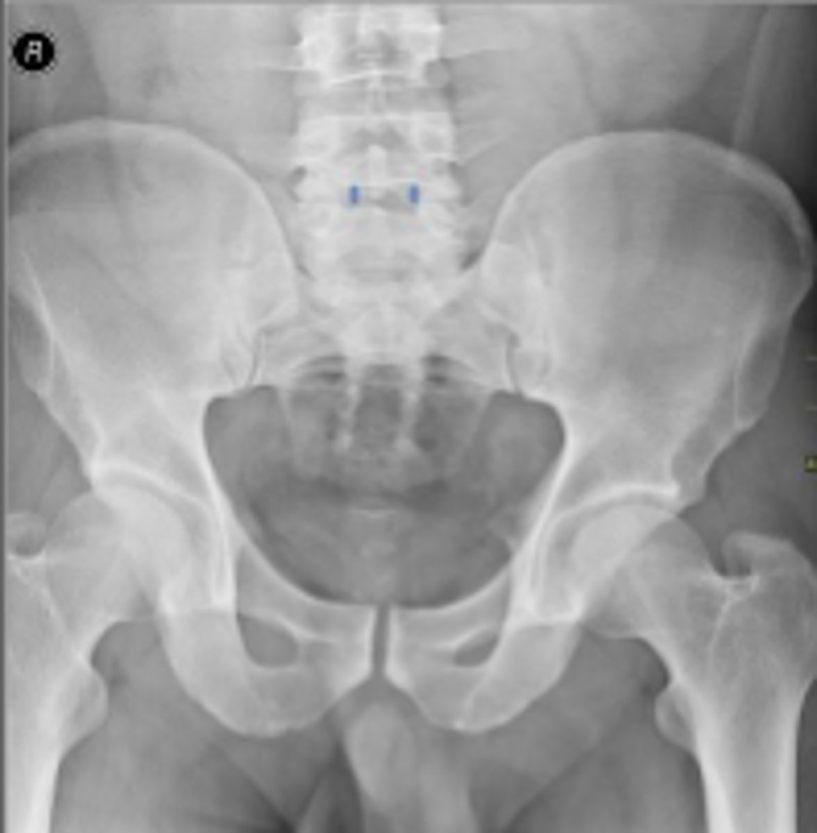 <p>Which IVD space is indicated by the arrows?</p>