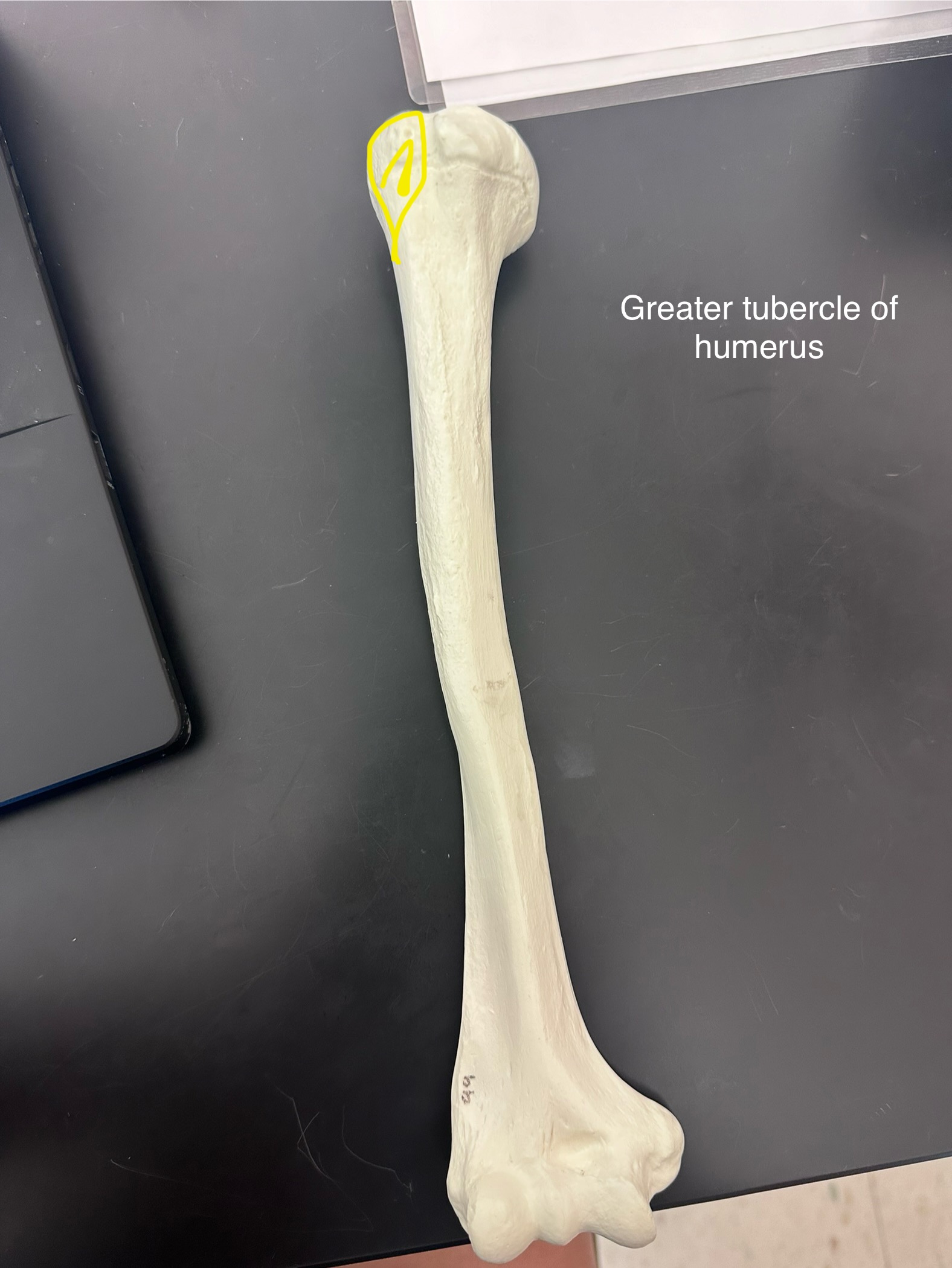 <p>Greater tubercle of humerus</p>