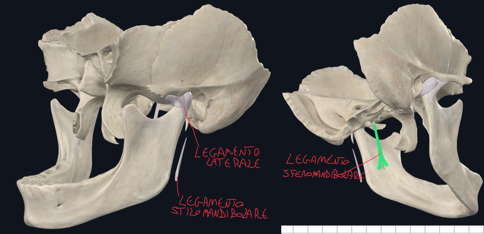 <p>La capsula articolare (lassa per consentire i movimenti del condilo e disco) si ispessisce lateralmente formando il LEGAMENTO LATERALE:</p><ul><li><p>E’ il principale legamento di rinforzo, infatti stabilizza l’articolazione</p></li><li><p>Inoltre limita i movimenti posteriori e laterali eccessivi del condilo</p></li></ul><p>Poi abbiamo il LEGAMENTO SFENOMANDIBOLARE:</p><ul><li><p>Che invece origina dalla spina dello sfenoide e si inserisce sulla lingula</p></li><li><p>E’ il fulcro dei movimenti di abbassamento della mandibola e limita l’apertura eccessiva</p></li></ul><p>Infine abbiamo il LEGAMENTO STILOMANDIBOLARE:</p><ul><li><p>Origina dal processo stiloideo e si inserisce sull’angolo della mandibola</p></li><li><p>Ha un ruolo secondario e più che un legamento osseo, è un ispessimento della fascia di connettivo che riveste la ghiandola parotide.</p></li></ul><p></p>