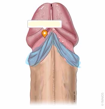 <p>What is the name of this highlighted structure ? ( the fold of skin covering the head of the penis typically removed during circumcision).</p>