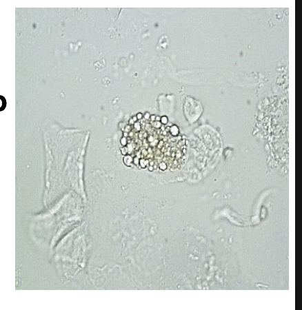 <ul><li><p class=""><span style="color: #ed8b05">Presence of <strong>fat in urine</strong></span></p></li><li><p class="">Confirm with <span style="color: red"><strong>Oil Red O</strong> or <strong>Sudan III</strong> stain</span></p></li></ul><p class=""><span style="color: #f37da4"><strong>Associated with</strong>:</span></p><ul><li><p class=""><span style="color: #08f82c"><strong>Nephrotic syndrome</strong> (glomerular damage)</span></p></li><li><p class=""><span style="color: #08f82c"><strong>Tubular necrosis</strong></span></p></li><li><p class=""><span style="color: #08f82c"><strong>Diabetes mellitus</strong></span></p></li><li><p class=""><span style="color: #08f82c"><strong>Trauma</strong> (bone marrow fat)</span></p></li><li><p class=""><span style="color: #08f82c"><strong>Lipid storage diseases</strong> → oval fat bodies from <strong>histiocytes</strong> (not RTE)</span></p></li></ul><p></p>