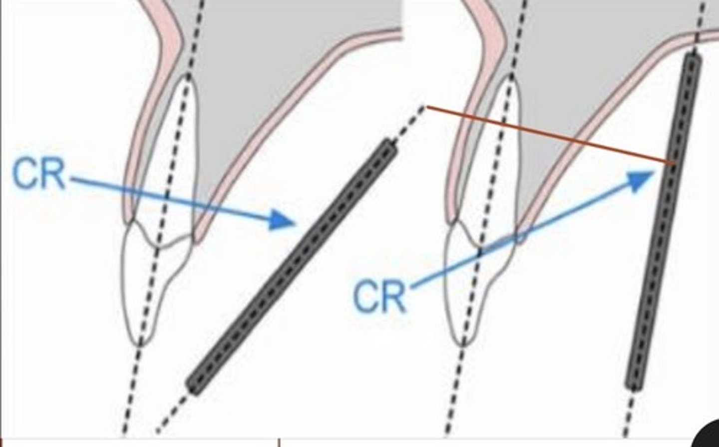 <p>decreased vertical angulation</p>