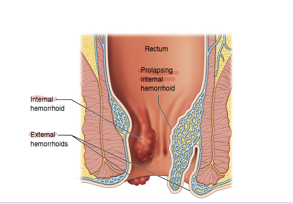 <p>A swollen vein or group of veins in the region of the anus </p>