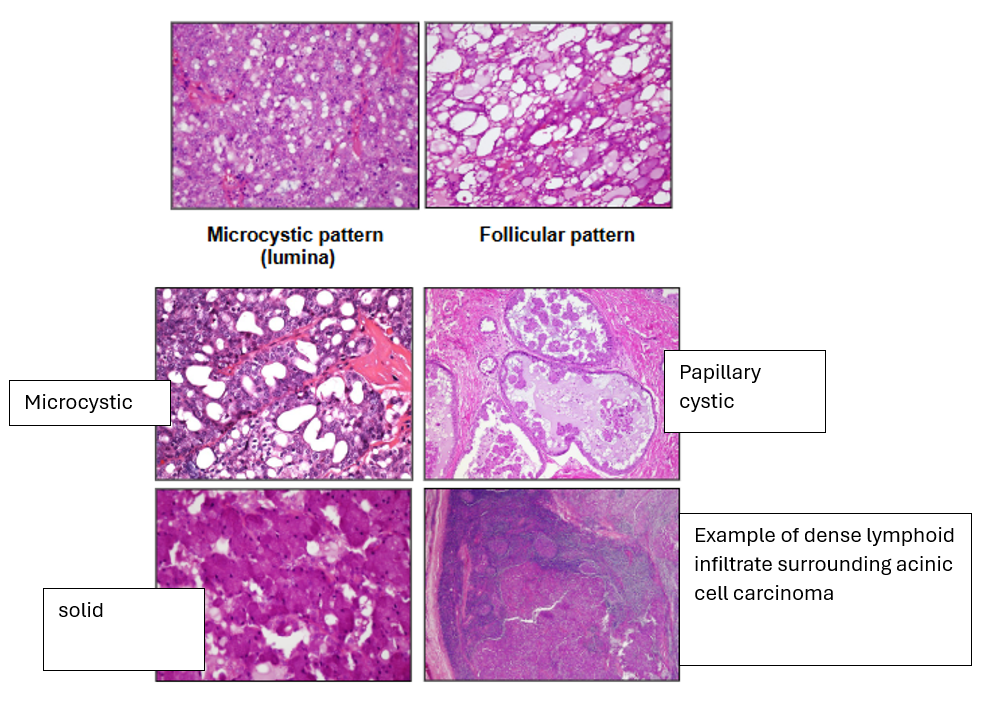 <p><span>1) Solid</span><br><span>2) Microcystic</span><br><span>3) Papillary Cystic</span><br><span>4) Follicular - larger cystic areas than microcystic</span></p><p>You can get lymphoid tissue surrounding it</p>