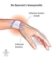 <ul><li><p><span>Stenosing(narrowing) tenosynovitis of the extensor pollicis brevis and abductor pollicis longus.</span></p></li></ul><p></p>
