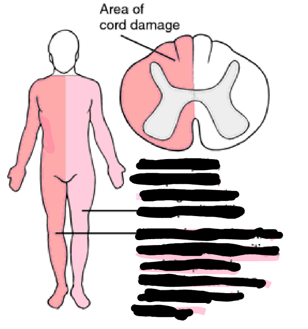 <p>Brown-Sequard Syndrome</p>