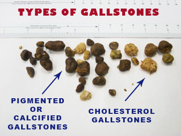 <ul><li><p class=""><strong>Cholesterol gallstones</strong> (90%): Form when <strong>bile becomes too concentrated</strong>, creating <strong>sludge</strong>; range from <strong>pea- to golf ball-size</strong>.</p></li><li><p class=""><strong>Pigment gallstones</strong>: Made from <strong>bilirubin salts</strong>, linked to <strong>infections</strong> or <strong>RBC breakdown</strong>; usually <strong>soft and crushable</strong>.</p></li></ul><p></p>