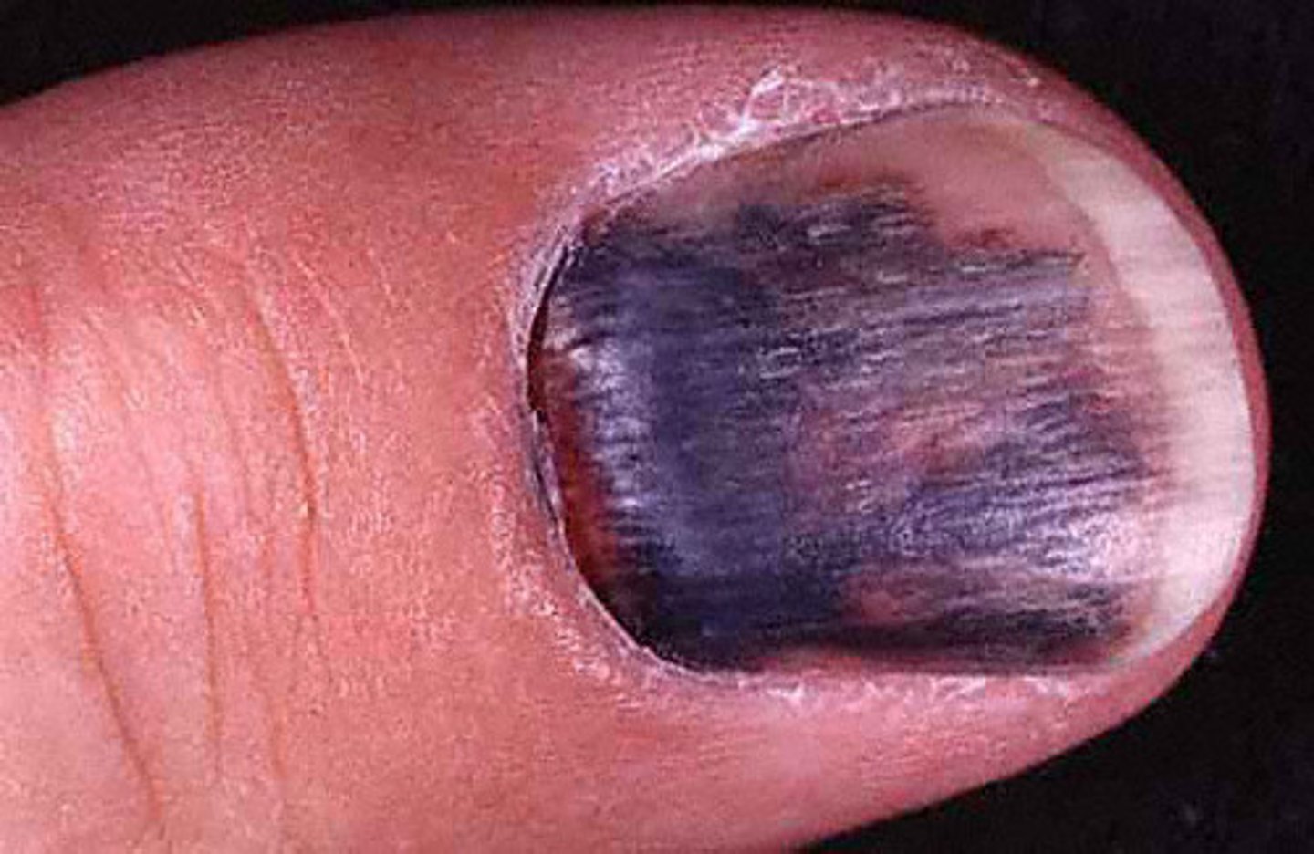 <p>bleeding under the nail</p>