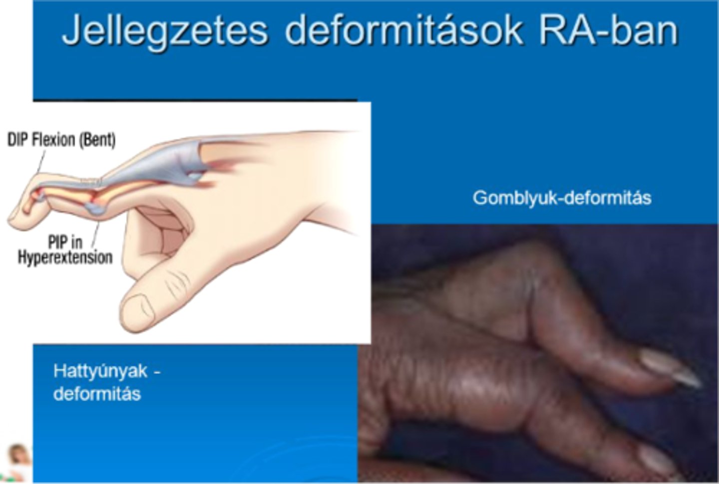 <p>MCP flexió</p><p>PIP hiperextensio</p><p>DIP flexió</p>