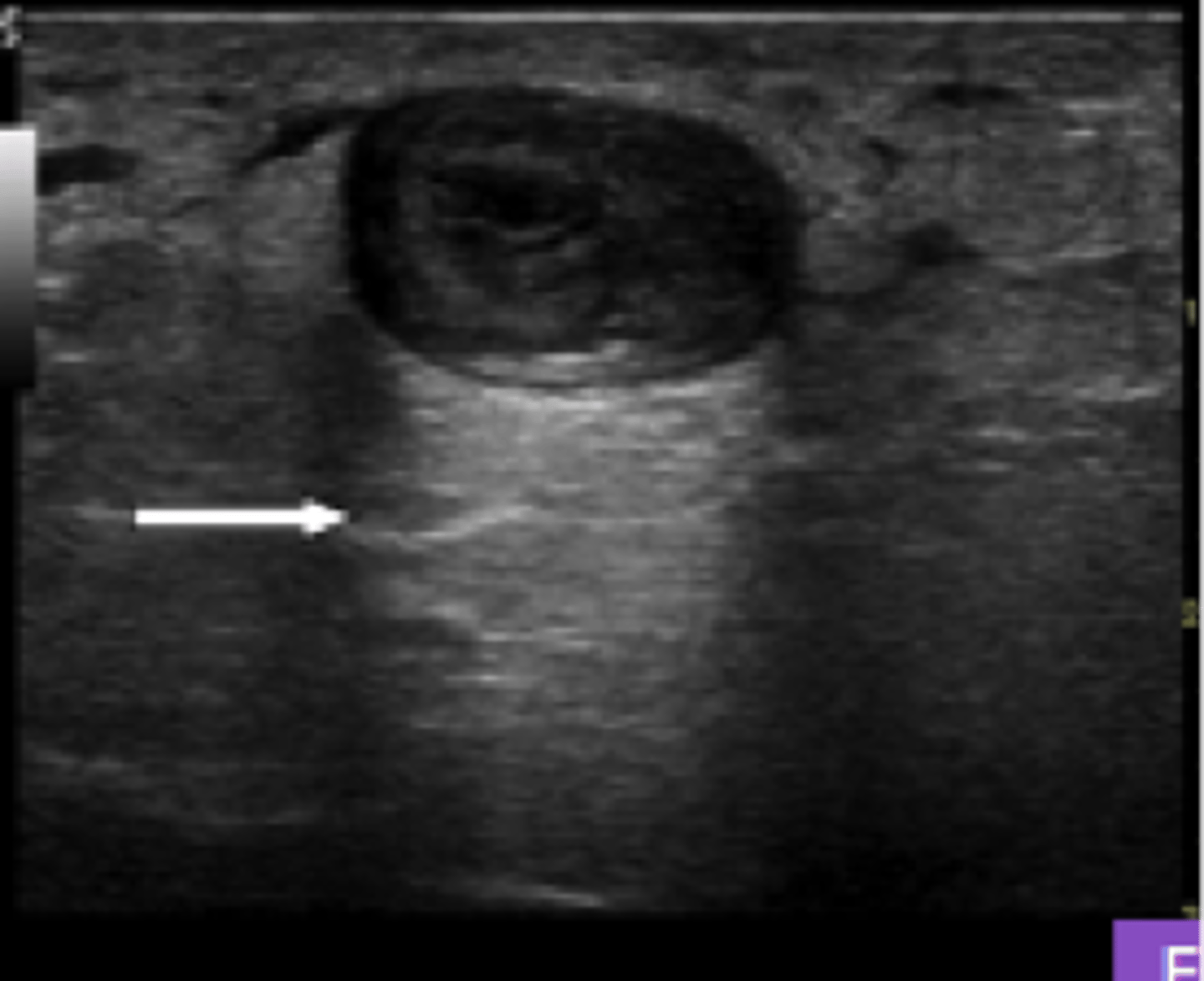<p>Increased echogenicity beneath low attenuating structures</p>