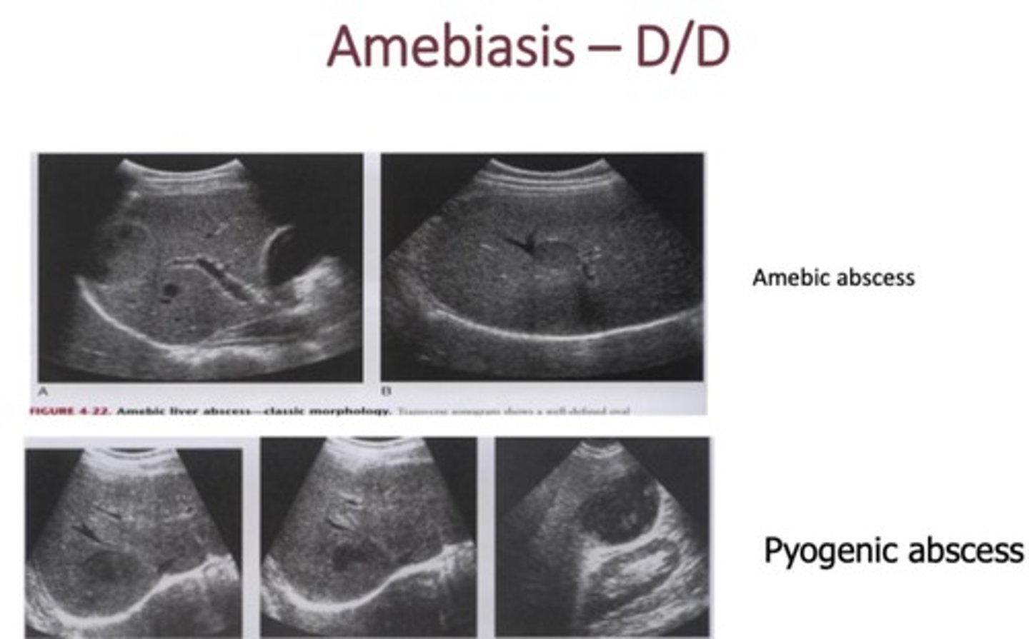 <p>- Round/oval shaped lesion</p><p>- Initially echogenic, later becomes uniformly hypoechoic</p><p>- Posterior enhancement</p><p>-Tends to be in rt liver lobe near diaphragm/hepatic flexure</p>