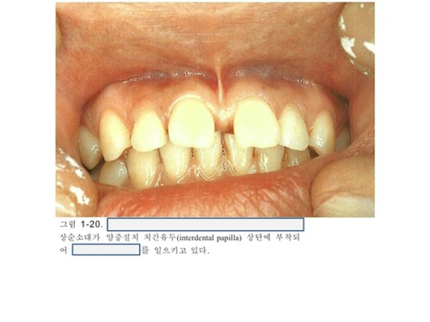 <p>-Space between two adjacent teeth</p><p>-Hereditary Trait</p><p>-Some factors that may contribute-frenum attachment and muscle pull.</p>