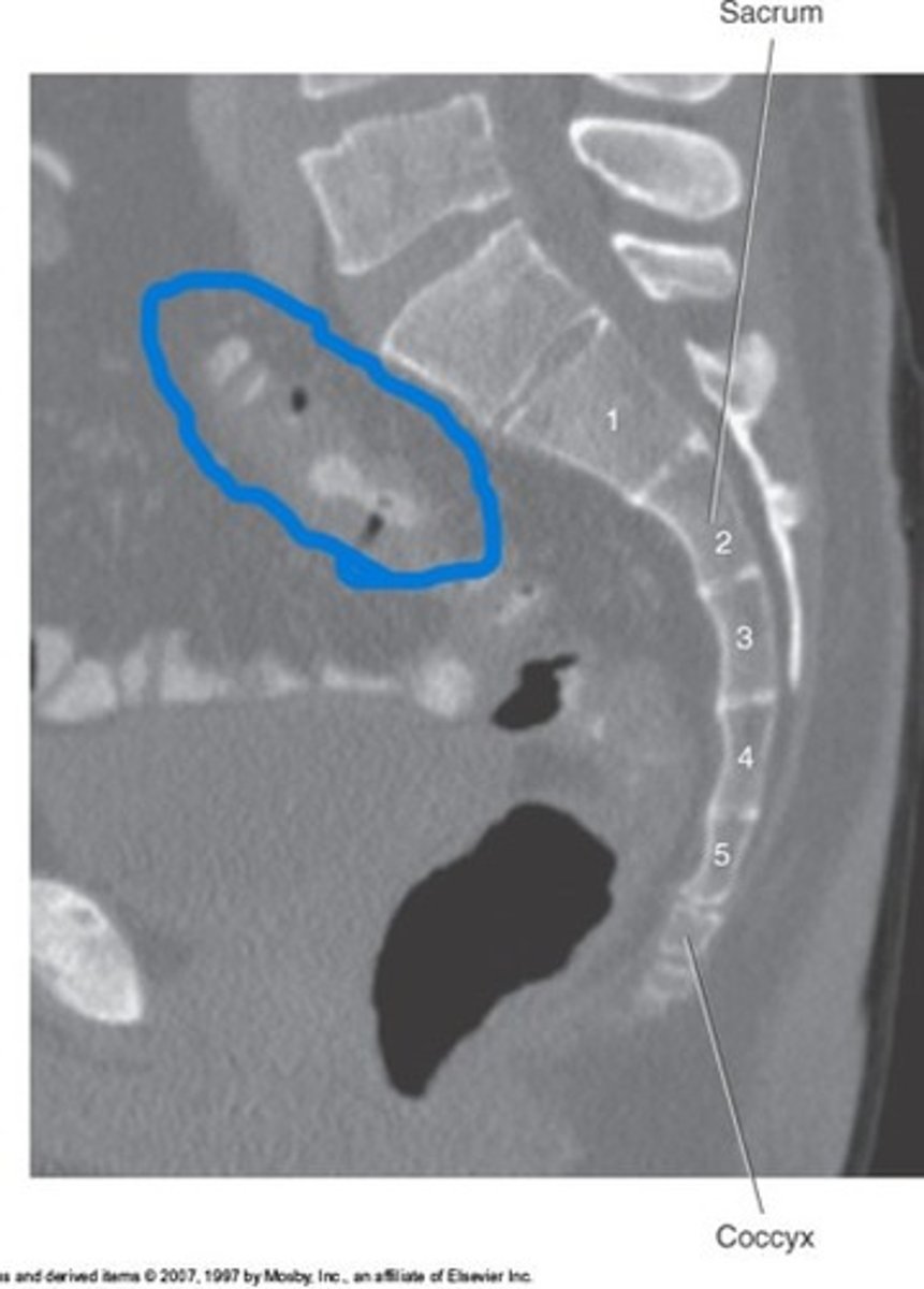 <p>What pathology is circled in blue</p>
