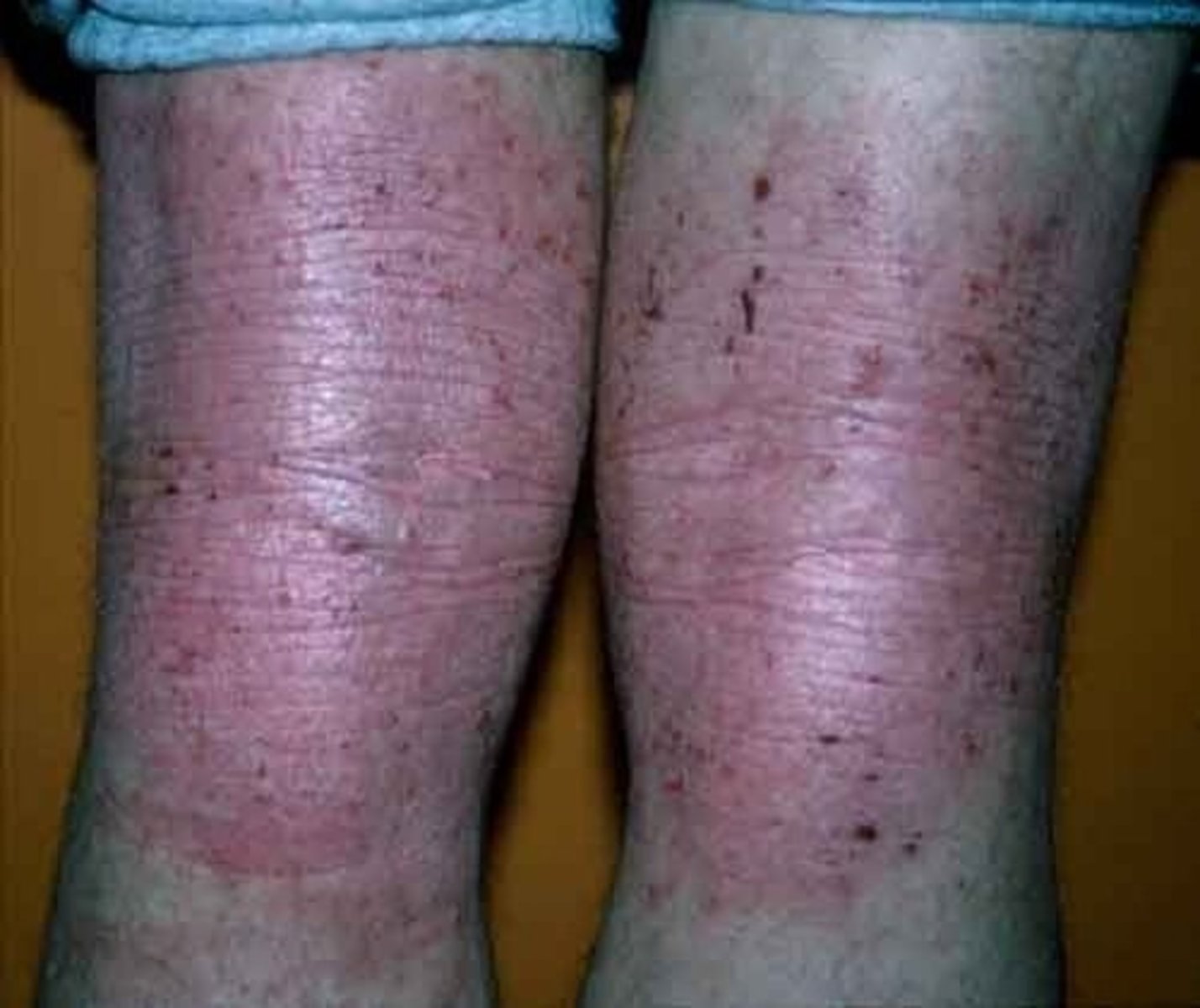 <p>thick, rough skin</p><p>chronic scratching</p><p>increased visibility of normal skin furrows</p>