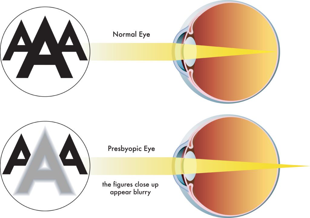 <p>a common age related condition that affects the eye’s ability to focus on near objects; why older people hold phones far away from themselves</p>