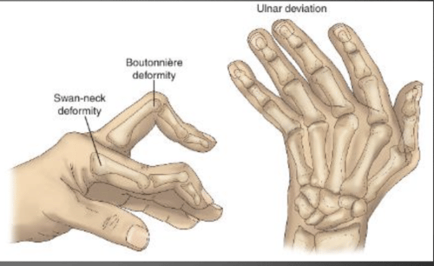 <p>structural changes in joints due to RA</p><p>- swan neck</p><p>- boutonniere</p><p>- hammer toe</p><p>- hyperextension</p>