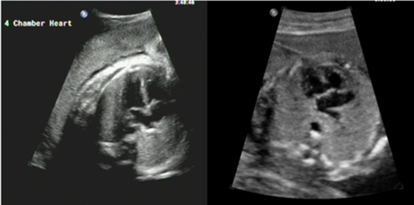 <p>identify the test that can survey for this heart defect:</p>