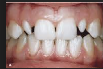 <p>lack of development of mesial or distal portions of crown (can be uni or bilateral, relatively common)</p>
