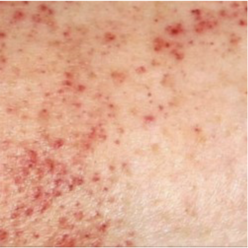 <ul><li><p>Platelet count &lt;20,000</p></li><li><p> Sudden onset of petechiae and bruising</p></li><li><p> Image shows petechiae</p></li><li><p> Frequent nose bleeds</p></li></ul><p></p>