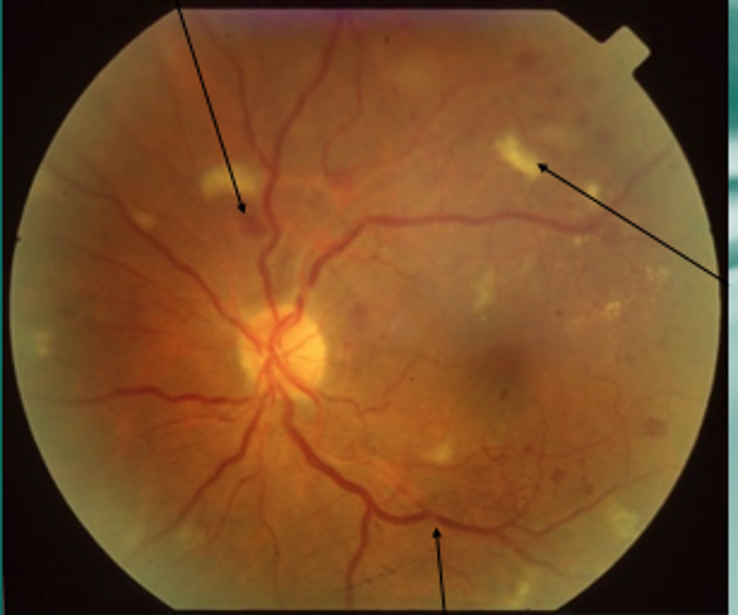 <p>Cotton wool spot; Diabetic Retinopathy (Non-proliferative)</p>