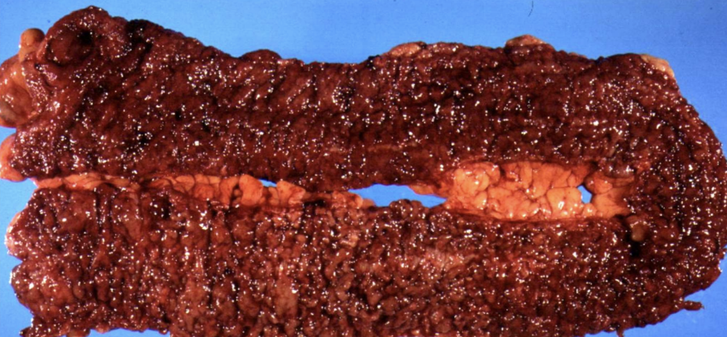 <p>A nonspecific but predictable response of <u>living tissue</u> to injury. Generally protective, can cause complications</p>