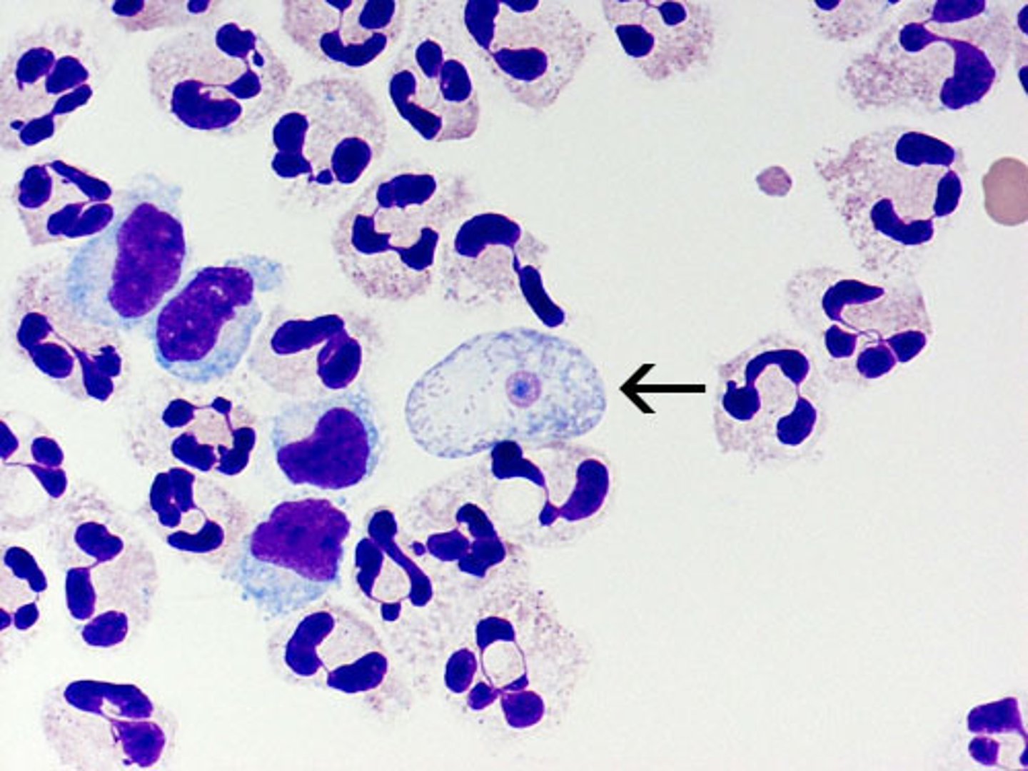 <p>Define CNS Infection Cause:</p><p>-Amebic Infection</p><p>-Rapidly fatal necrotizing encephalitis</p>