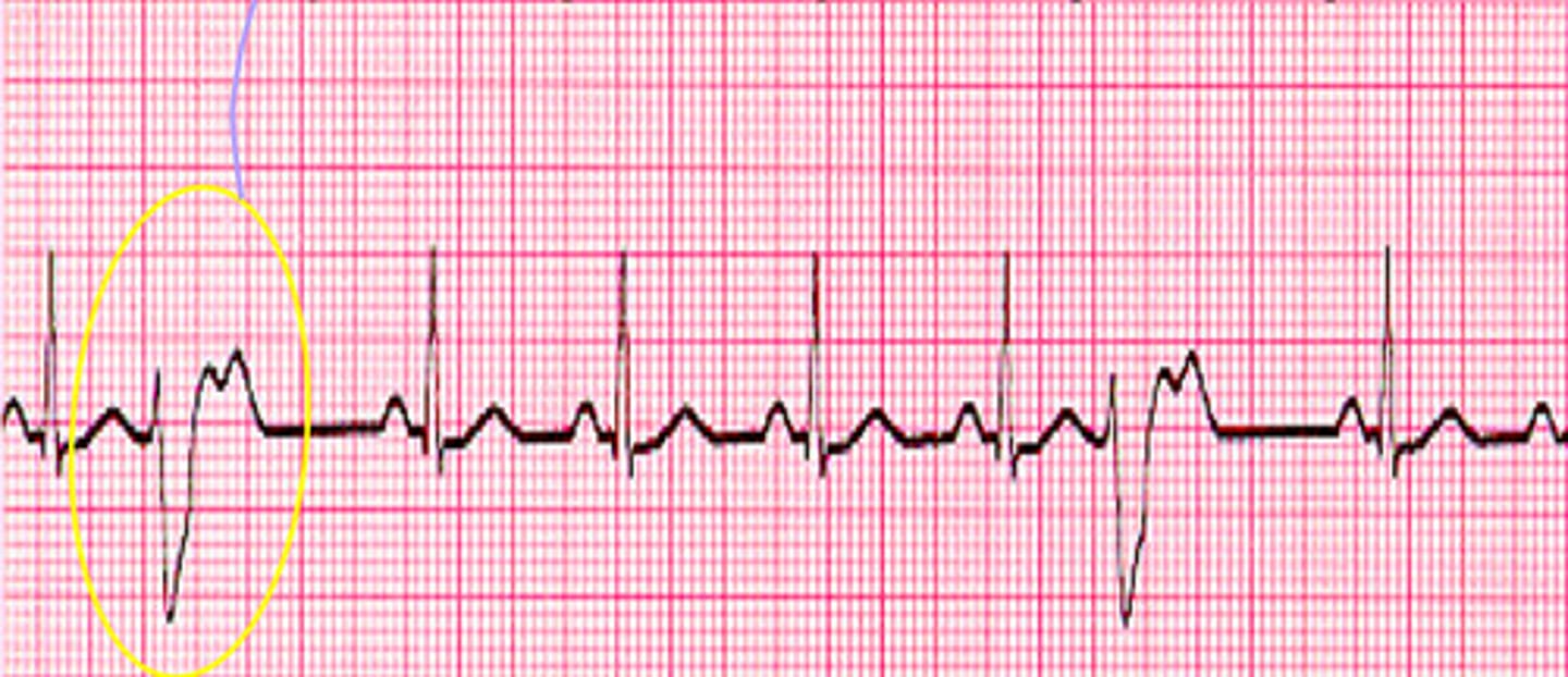 <p>What does the ECG show?</p>