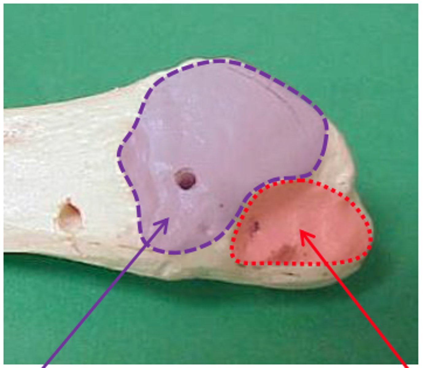 <p>flat, medially facing, triangular surface whose APEX faces inferiorly (purple in image)</p>