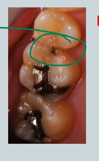 <p>is this arrested caries or is there an active lesion? is there cavitation? is it deep into dentine?</p><p><em>knowing the answer will help determine how much the patient is at risk of caries at the time you detect it </em></p>