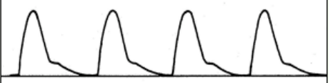 <p>Pressure of the pulse: increased</p><p>contour: rapid rise and fall, peak brief</p><p>Causes: increased stroke volume, decreased peripheral resistance (fever, anemia, and hyperthyroidism all potential causes), and decreased compliance (aging and atherosclerosis common offenders)</p>