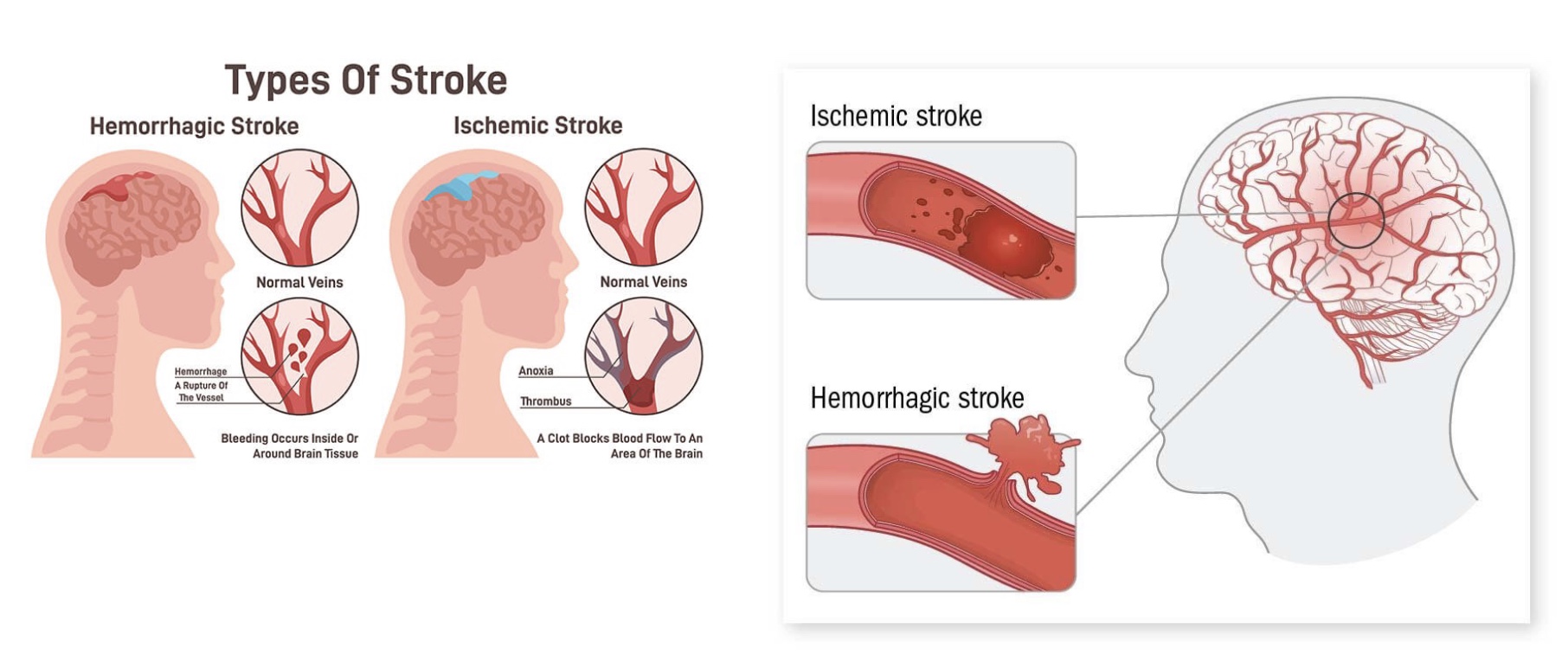 <p>-disrupt blood flow to brain; causes disfunction so need rehab</p><p><strong>-Hemorrhagic Stroke</strong>: vessel ruptures, brain bleed, swelling</p><p><strong>-Ischemic Stroke:</strong> clot formation; treat with powerful clot medicine</p>