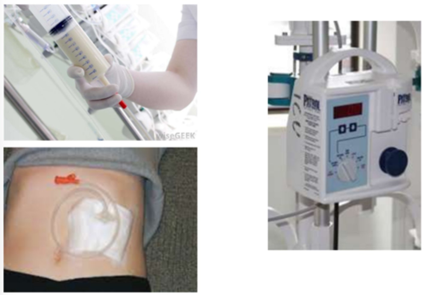 <p>Establish access to stomach/jejunum directly from skin.</p>