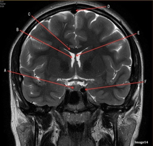 <p>Letter D in Image 14 is pointing to:</p><p>A. Tentorium</p><p>B. Sphenoid sinus</p><p>C. Frontal Sinus</p><p>D. Sagittal sinus</p><p>E. Fornix</p>