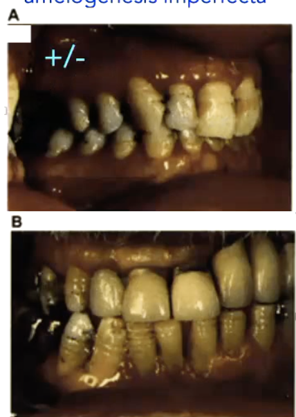 <p>nonsense mutation in enamelin gene results in hypoplastic amelogenesis imperfecta</p>