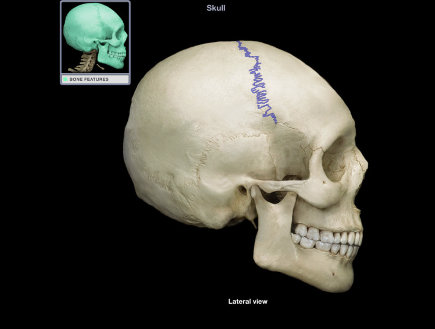 <p>Coronal suture</p>