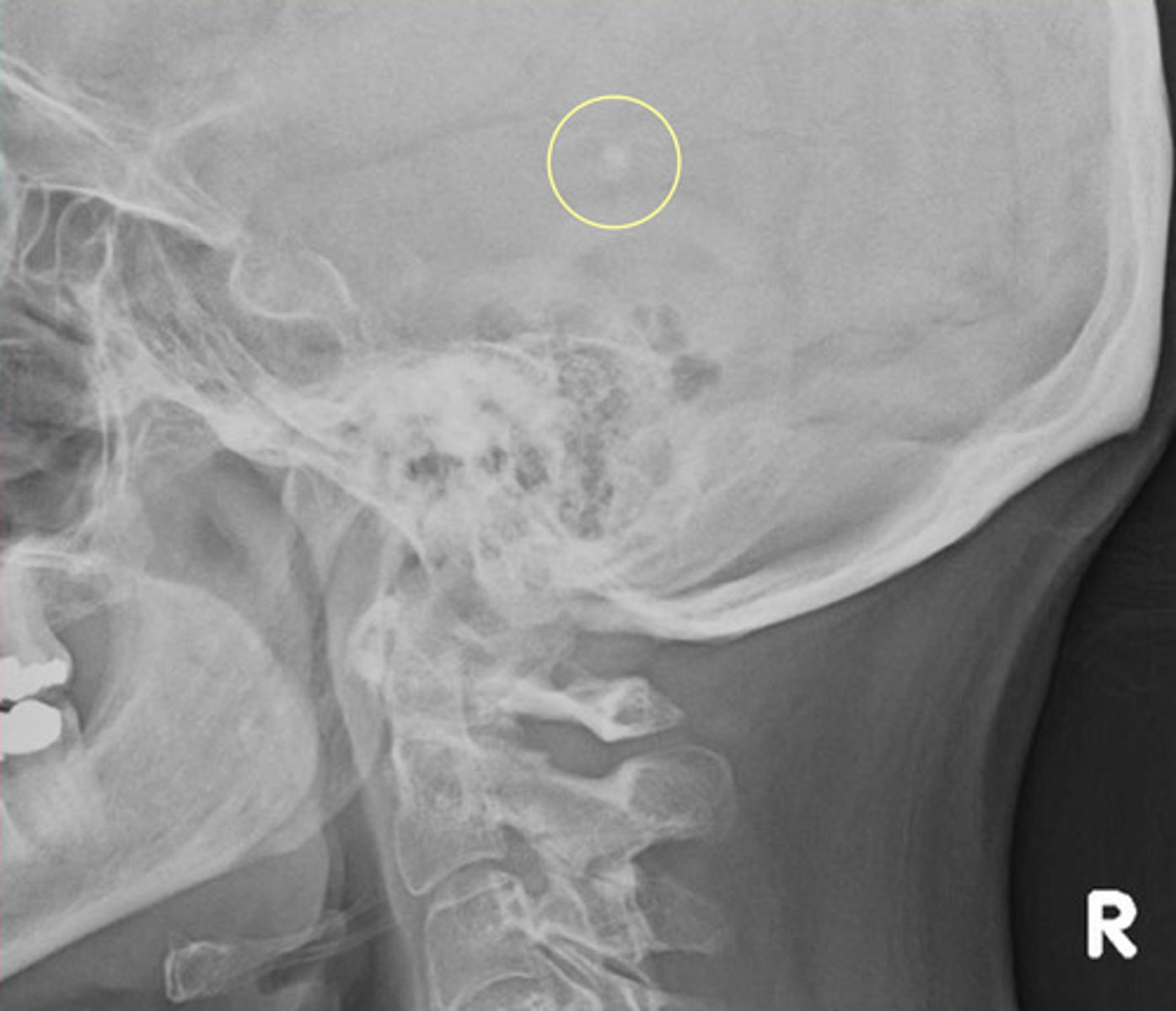 <p>Physiological calcification in about 50% of the population</p>