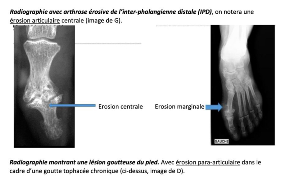 <p>=ostéolyse </p><p><span>→ intra-articulaire : centrale (touchant l'os sous-chondral) ou marginal </span></p><p><span>→ para-articulaire (à distance de la capsule synoviale) : goutte</span></p><p></p>