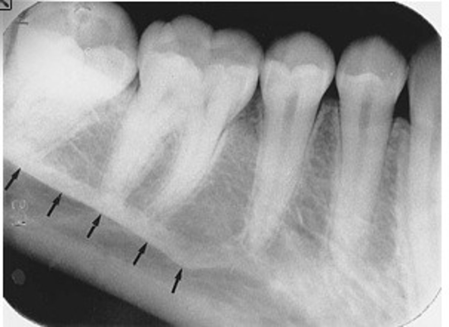 <p>What is the radiopaque structure seen here?</p>