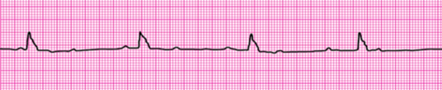 <p>Third-degree Atrioventricular block</p>