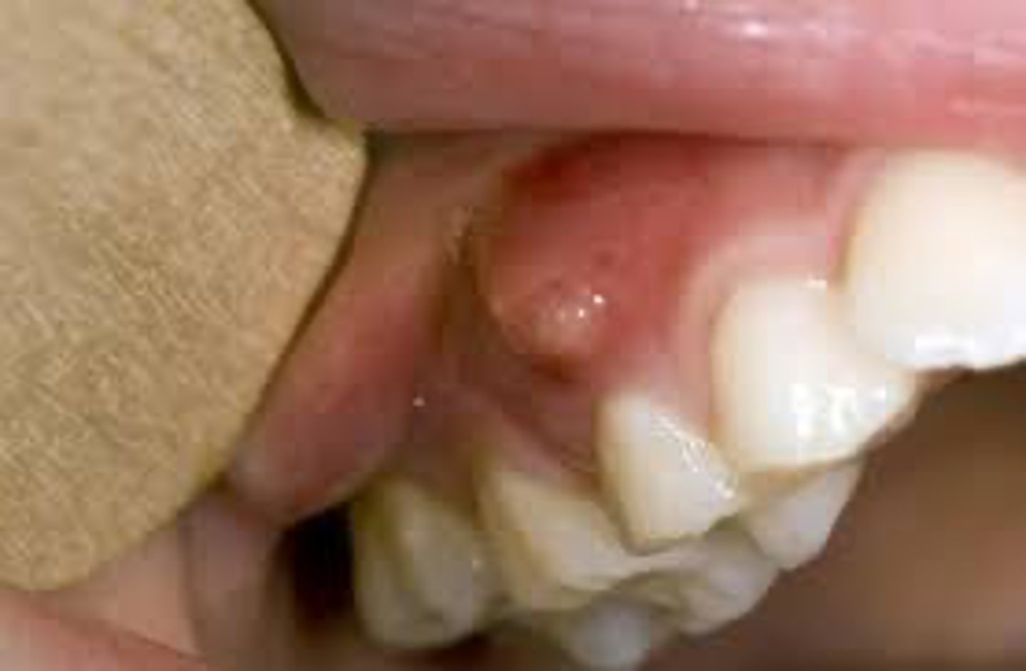 <p>A patient presents with a small, red-yellow bump on the gingiva near a non-vital tooth. The lesion appears to contain pus.</p><p>What is the most likely diagnosis?</p>