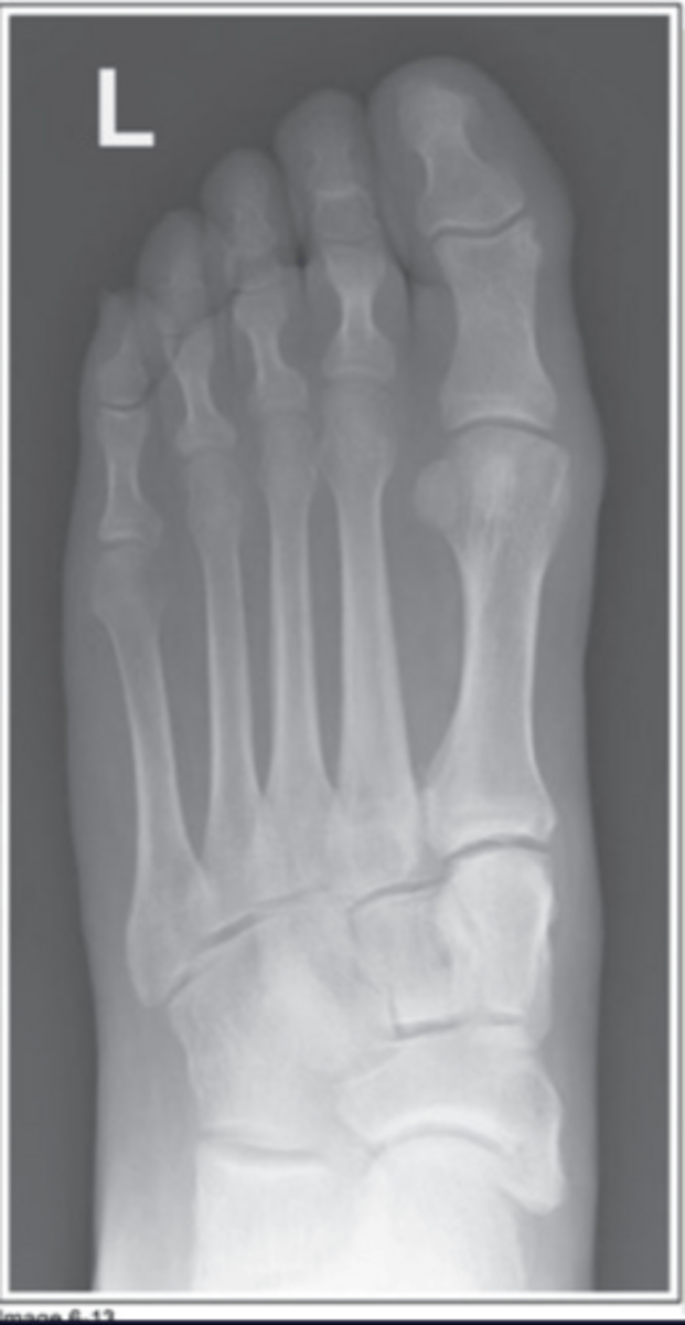 <p>Rotated medially</p>