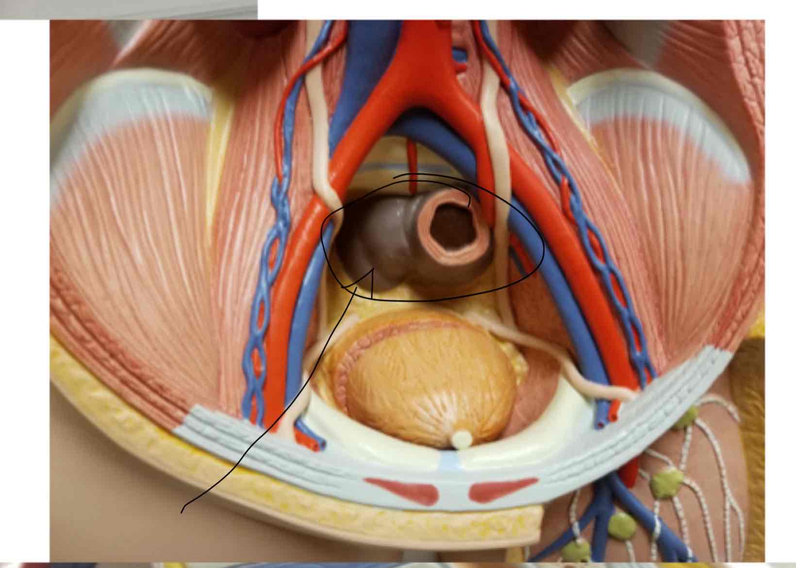 <p>Sigmoid Colon</p>