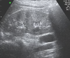 <p>Sonographically, renal papillary necrosis (RPN) appears as round or triangular ___ spaces at the ___ junction </p>
