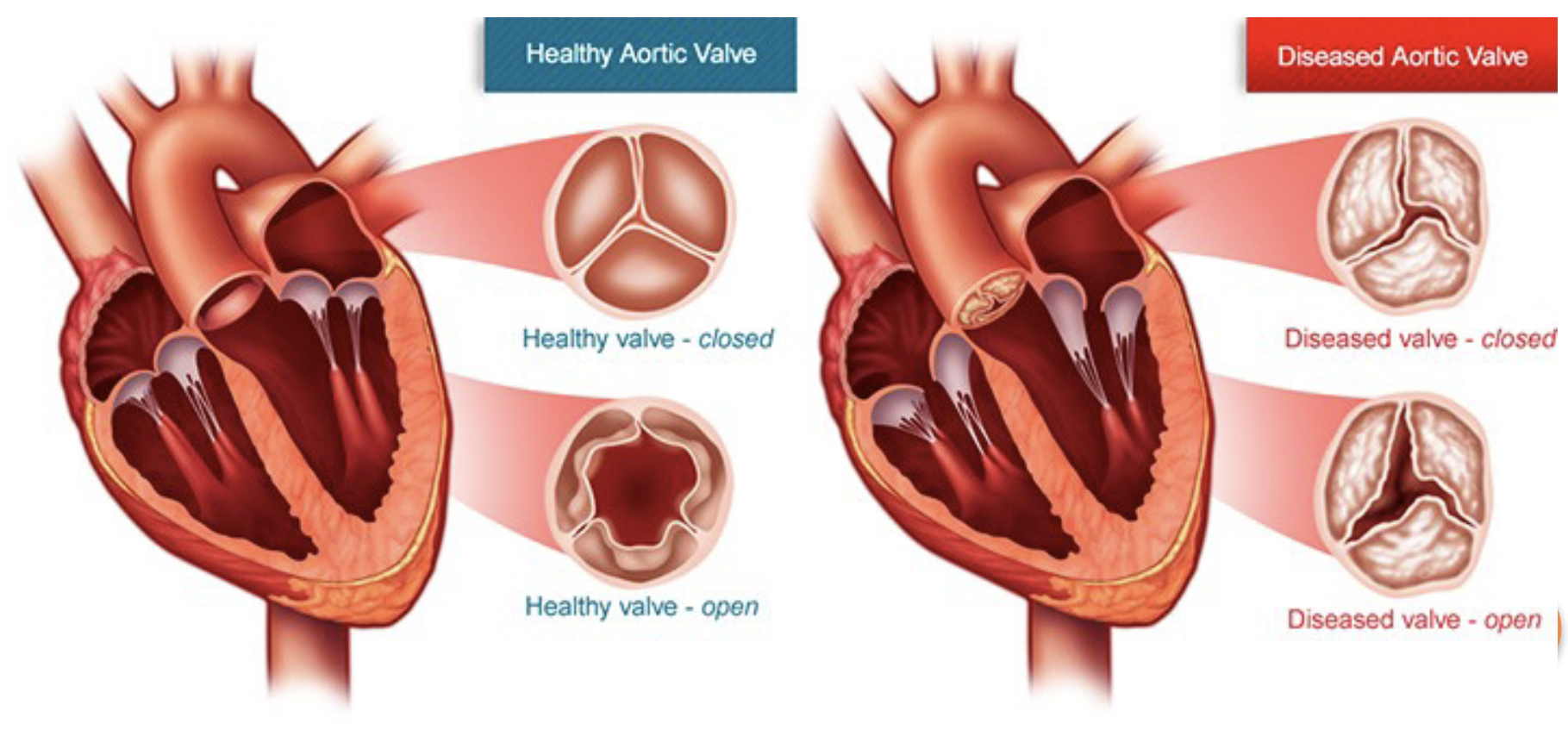 <p>Aortic Stenosis</p>