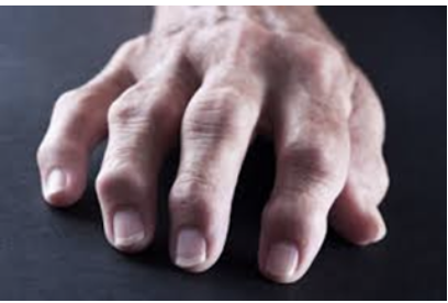 <p><span>Which joint deformity is shown here?</span></p><p></p>