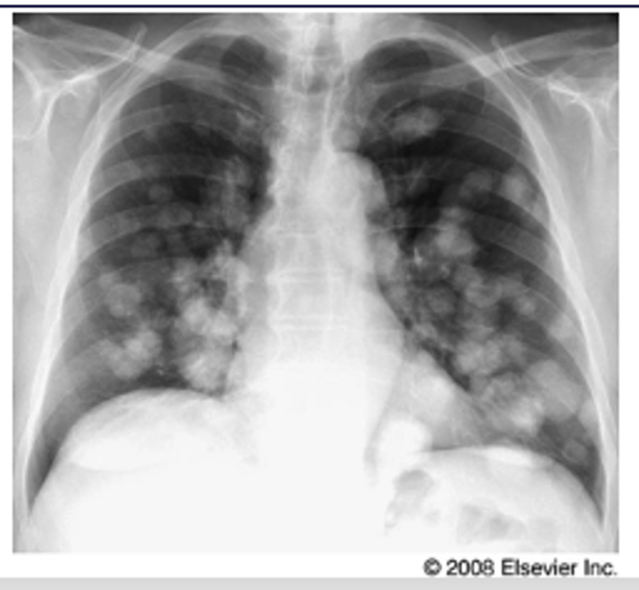 <p>Nodular pattern resulting from multiple small metastases to the lung from a colonic adenocarcinoma</p>