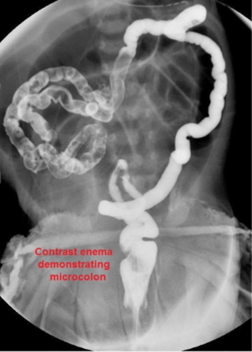 <p>Initial: abdominal x-ray - shows multiple loops of small bowel in "soap-bubble" appearance</p><p>F/U: upper GI contrast series &amp; contrast enema - shows microcolon inspissated w/ meconium</p>
